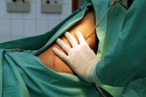 Lipoaspiration et Lipomodelage - Dr Iris Popa